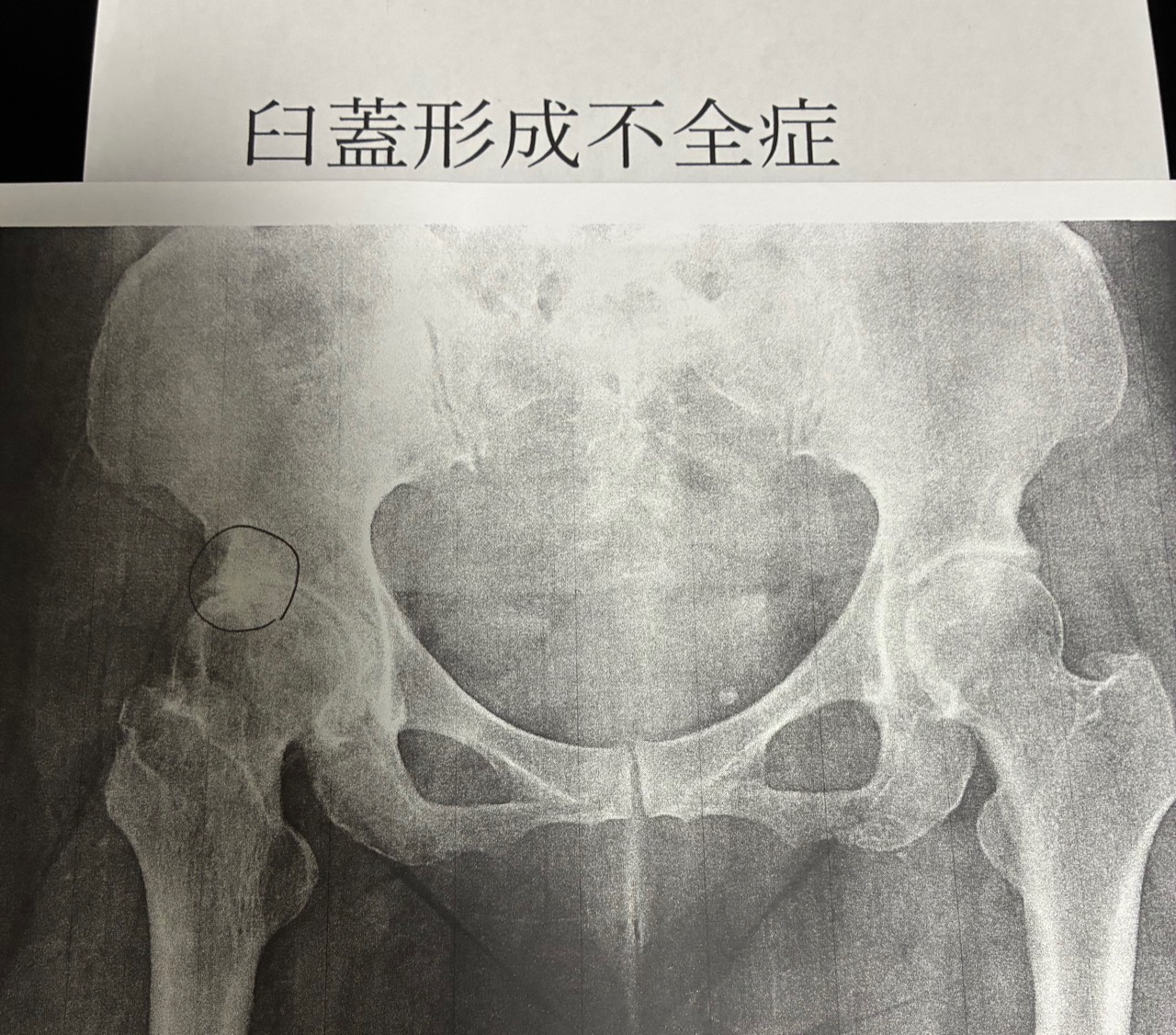 股関節痛で整形外科へ紹介し臼蓋形成不全症の診断名がついた資料